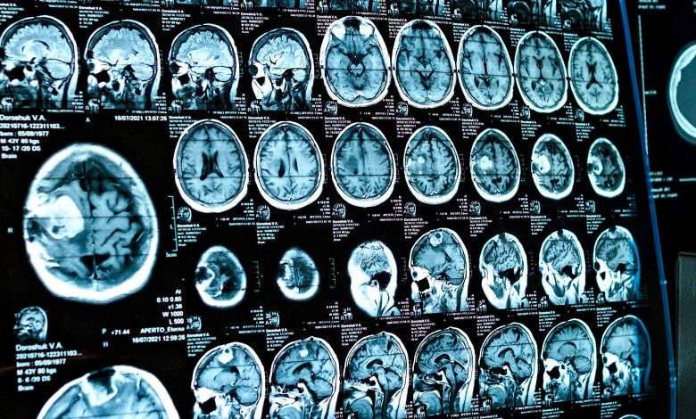 COVID impact cerveau adolescents