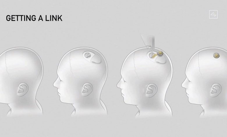 Elon Musk promises to implant connected implants in the human brain within six months